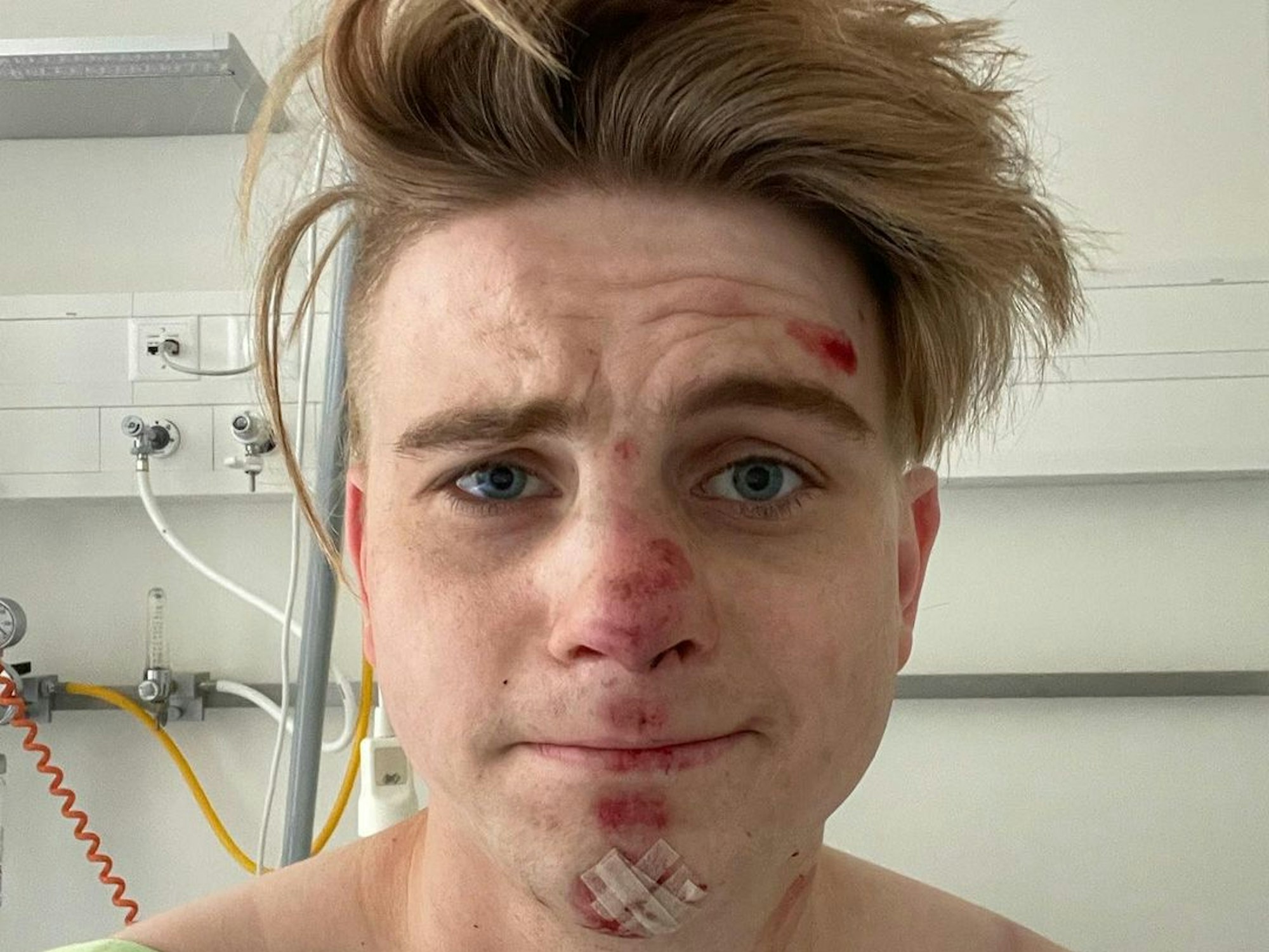 Vincent Gross im Krankenhaus mit Schürfwunden im Gesicht