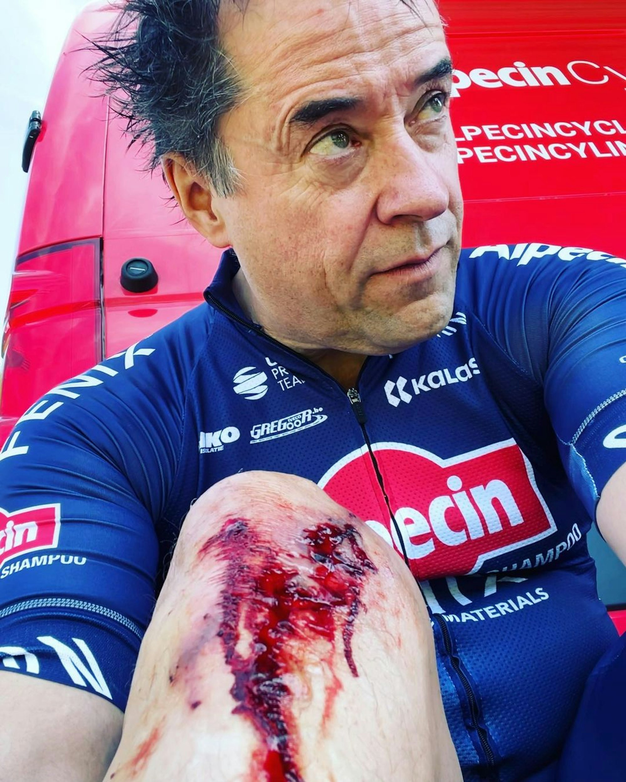 Schauspieler Jan Josef Liefers zeigt sein blutiges Knie