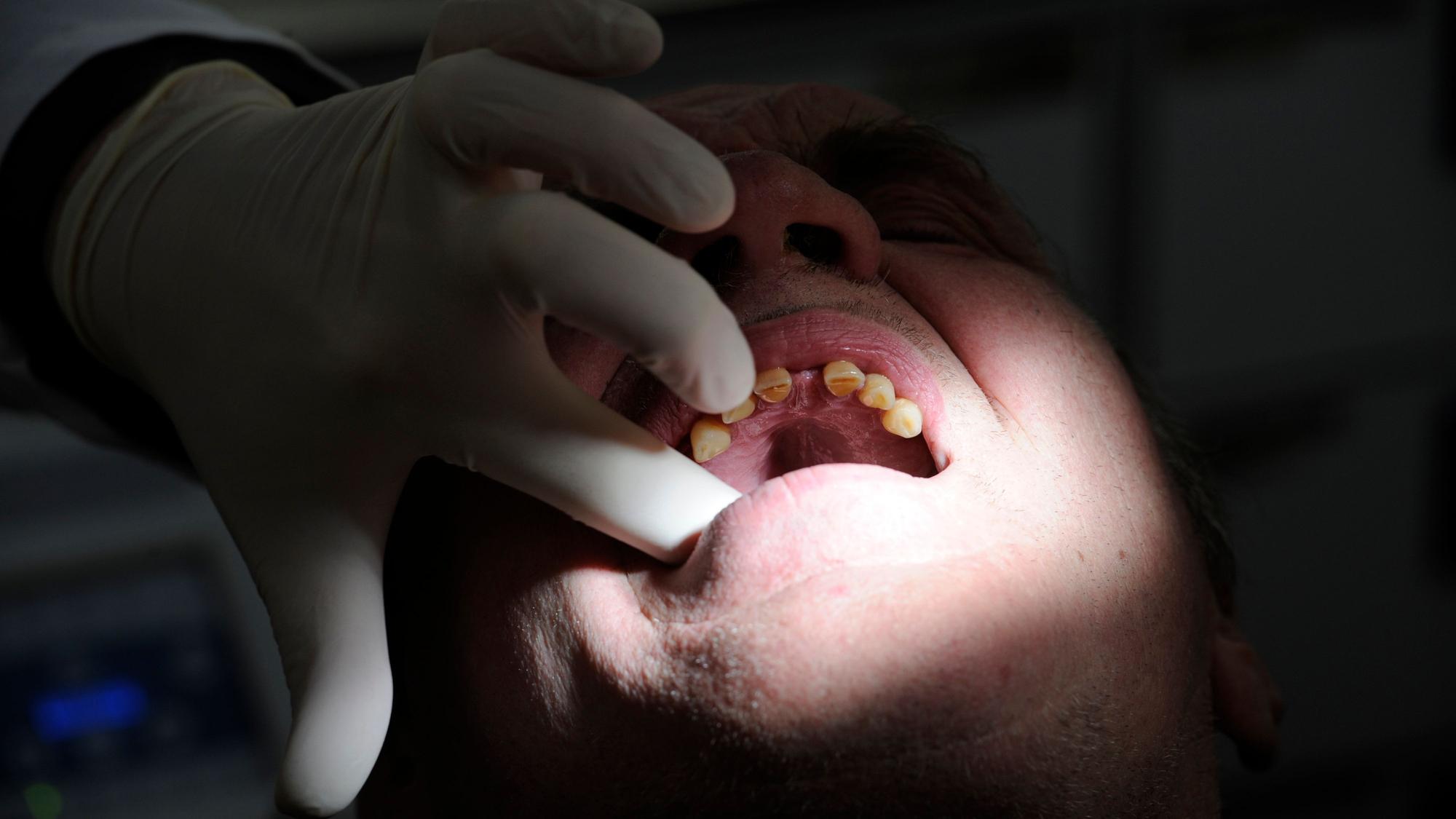 Dieses Bild vom 24. Februar 2010 zeigt die zahnärztliche Behandlung eines Patienten in Hamburg.