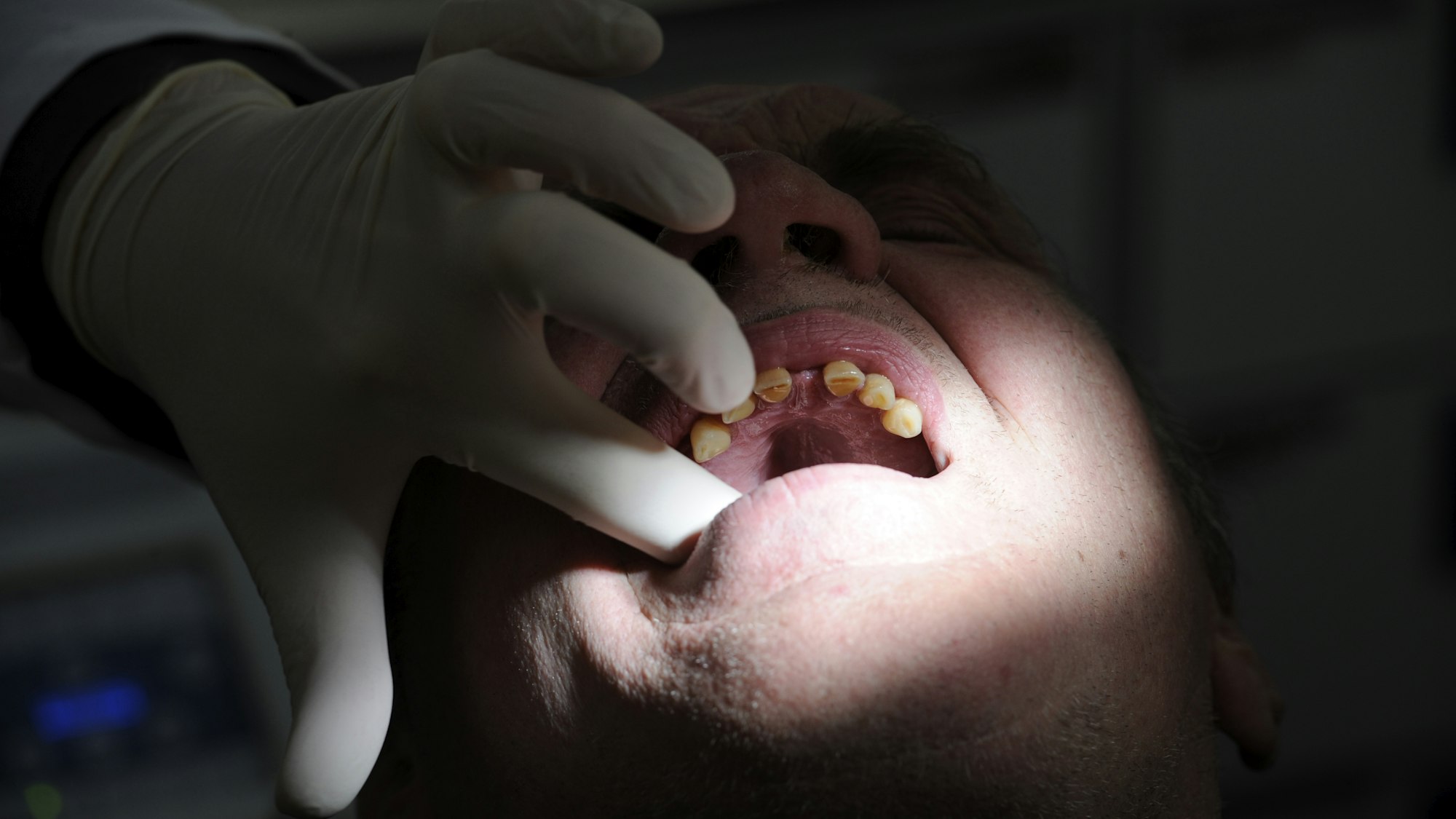 Dieses Bild vom 24. Februar 2010 zeigt die zahnärztliche Behandlung eines Patienten in Hamburg.