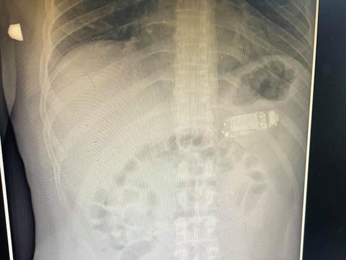 Facebook Skender Telaku am 30.8.2021 Röntgenbild von einem Patienten mit Handy im Magen.