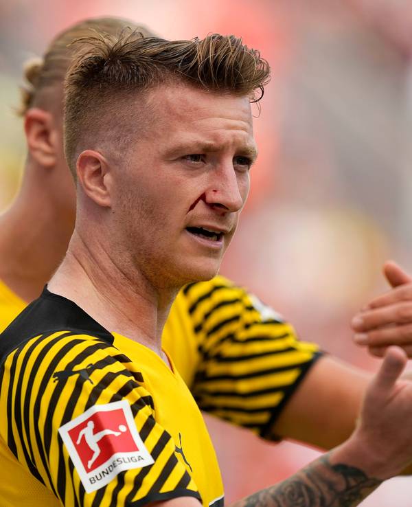 Dortmunds Marco Reus mit Gesichtsverletzung beim Spiel gegen Leverkusen.
