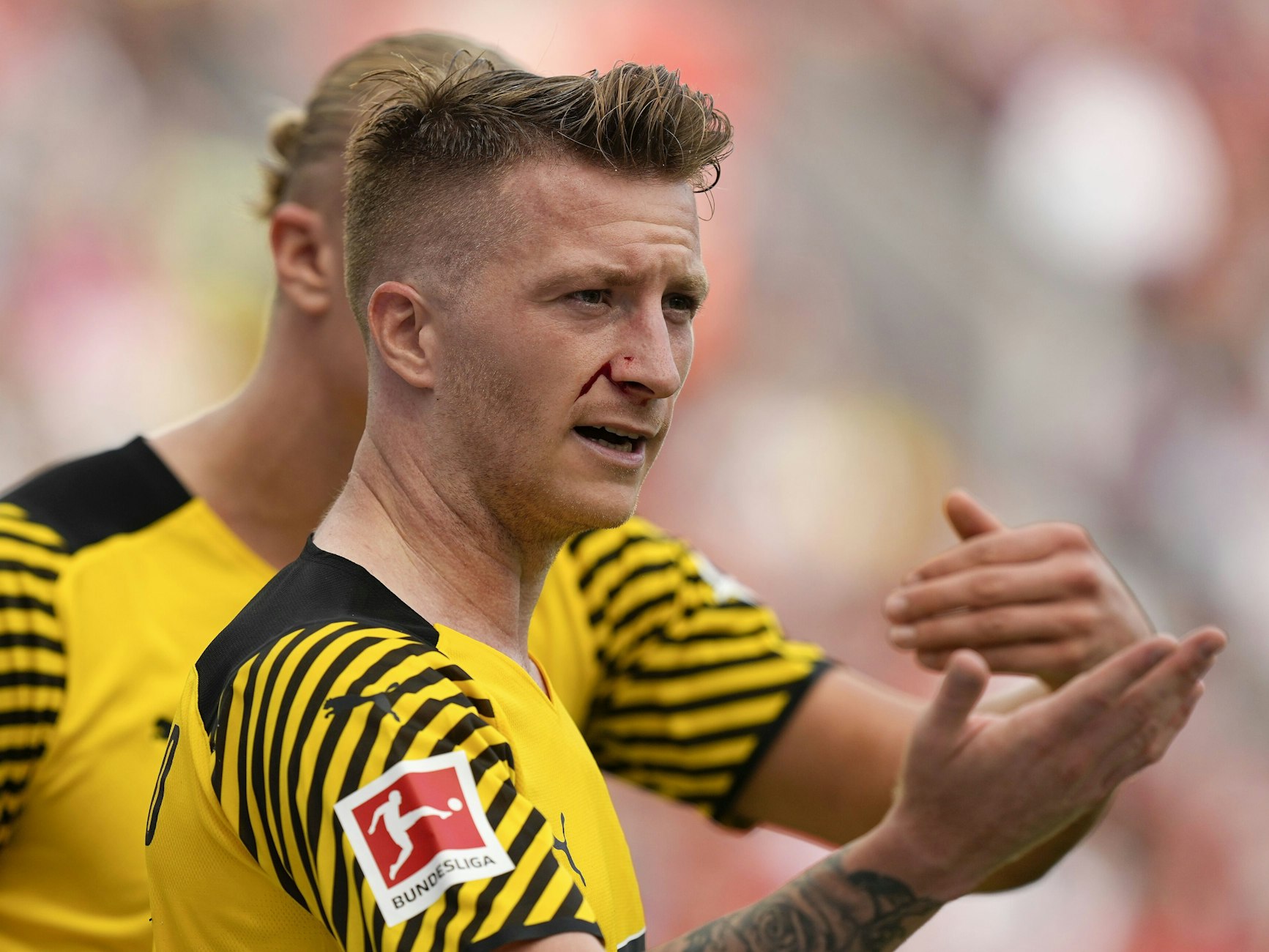 Dortmunds Marco Reus mit Gesichtsverletzung beim Spiel gegen Leverkusen.