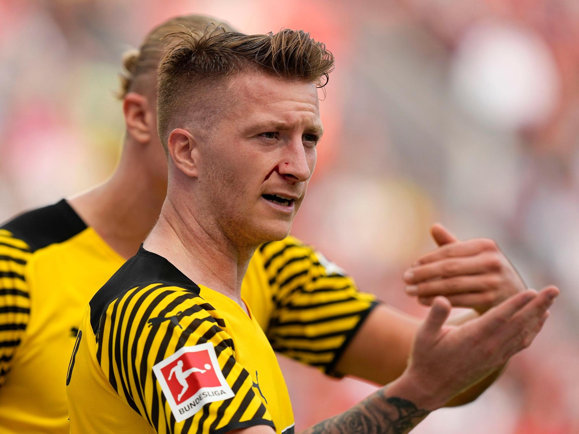 Dortmunds Marco Reus mit Gesichtsverletzung beim Spiel gegen Leverkusen.