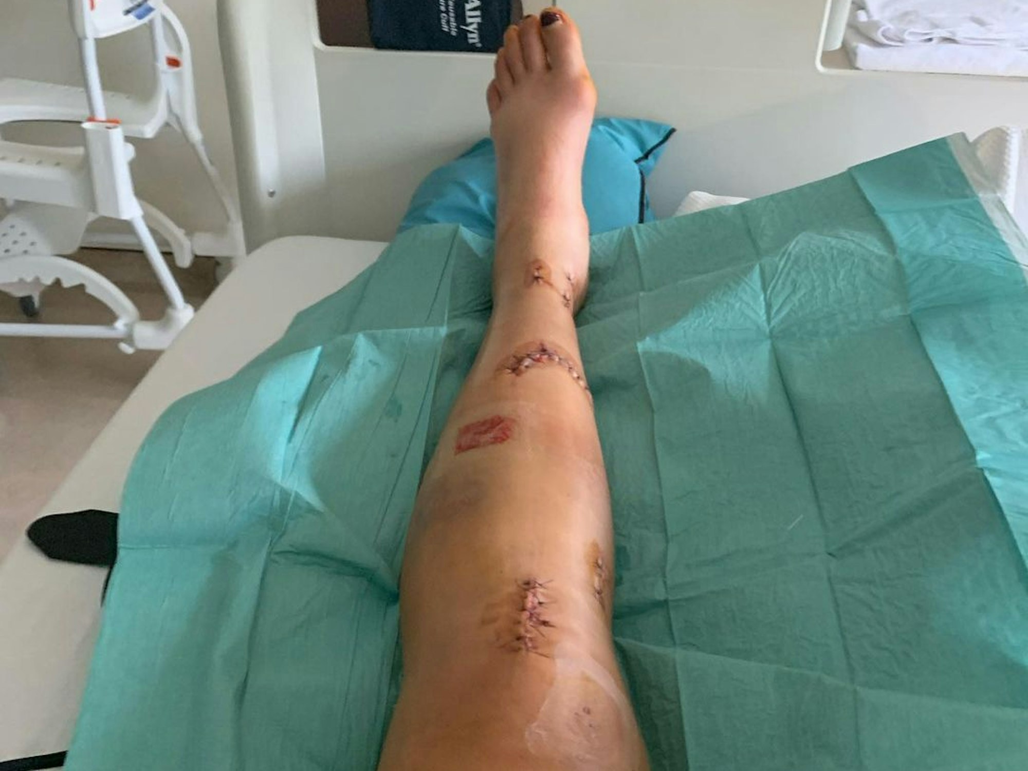 US-Ski-Star Alice Merryweather zeigt ihr operiertes linkes Bein auf Instagram (Beitrag vom 11. September 2021).