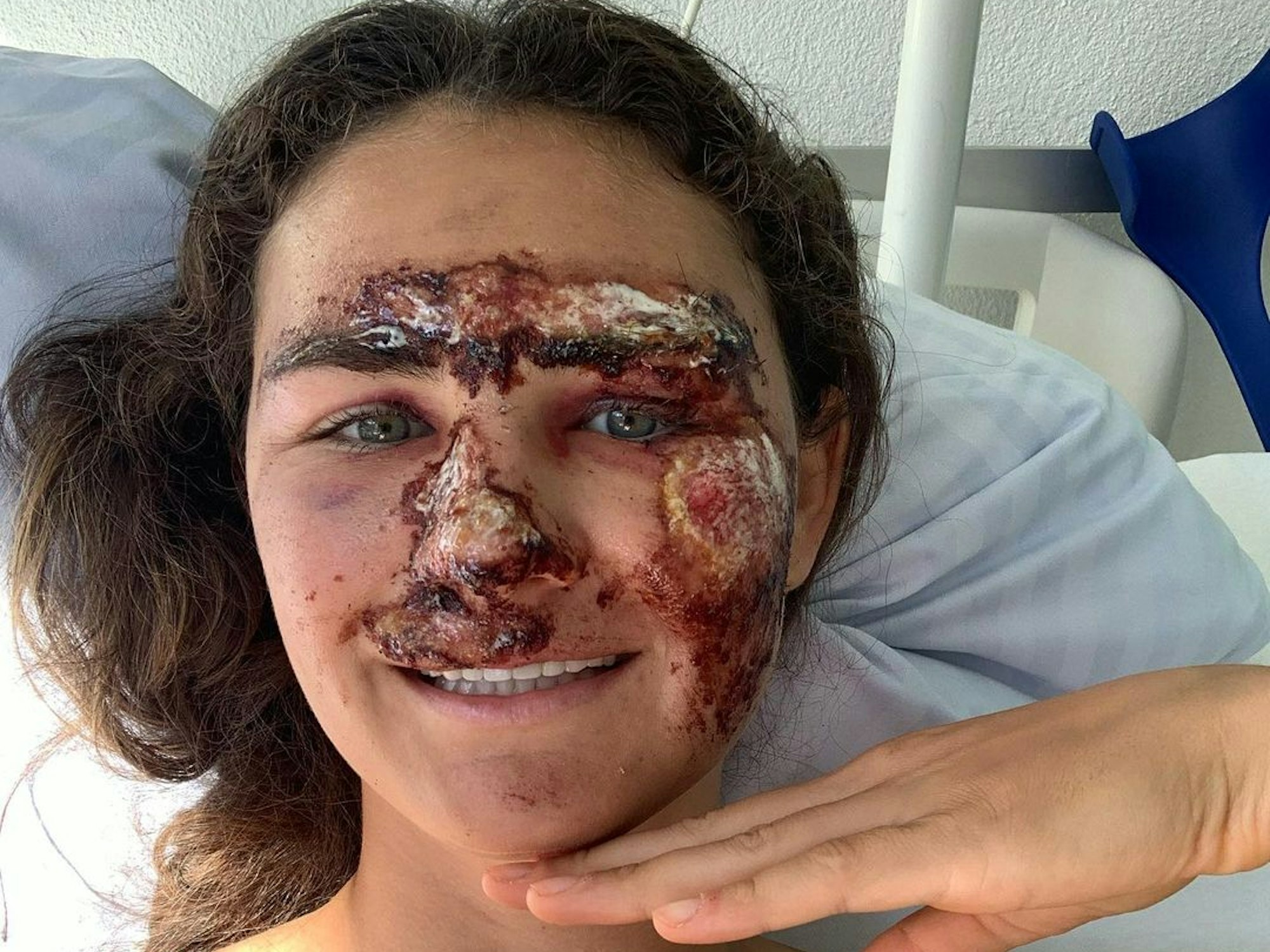 US-Ski-Star Alice Merryweather zog sich bei einem Trainings-Sturz im Schweizerischen Saas Fee am Mittwoch (8. September 2021) schwere Verletzungen zu.