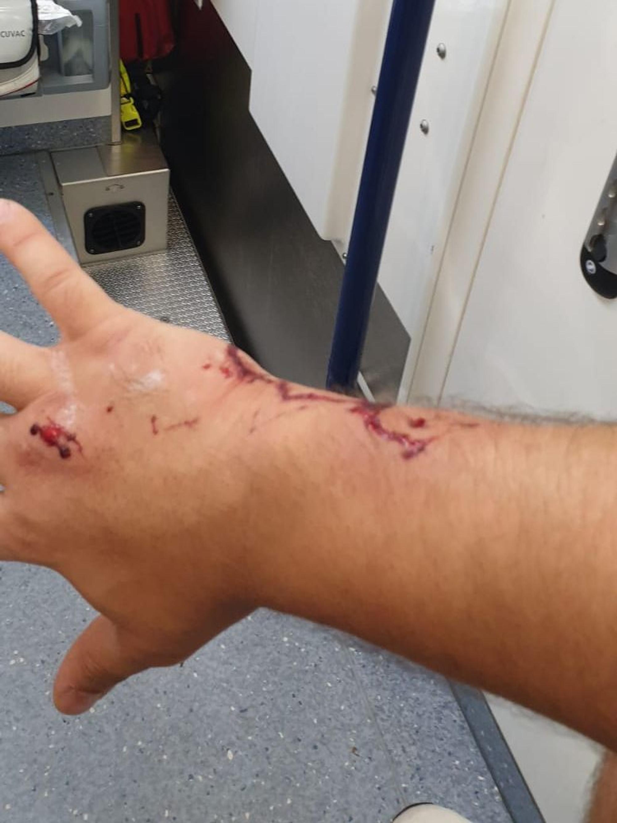 Der Kölner Murat K. zeigt seine verletzte Hand nach einem Hundebiss.