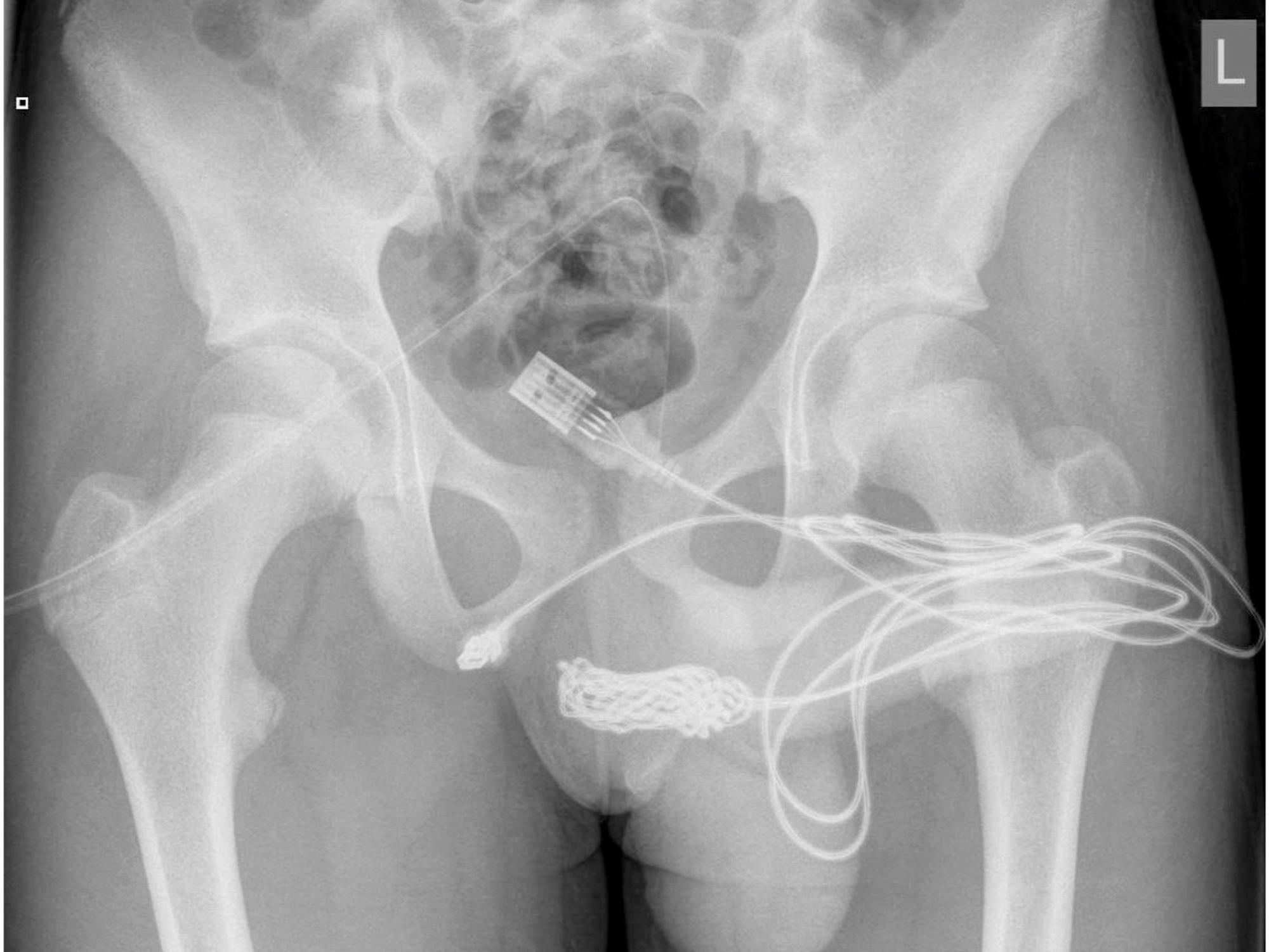 Auf dem Röntgenbild ist deutlich das verknotete USB-Kabel zu sehen, das im Körper des Jugendlichen stecken geblieben war. Der Teenager führte es bei einem fehlgeschlagenen sexuellen Experiment in seinen Penis ein.