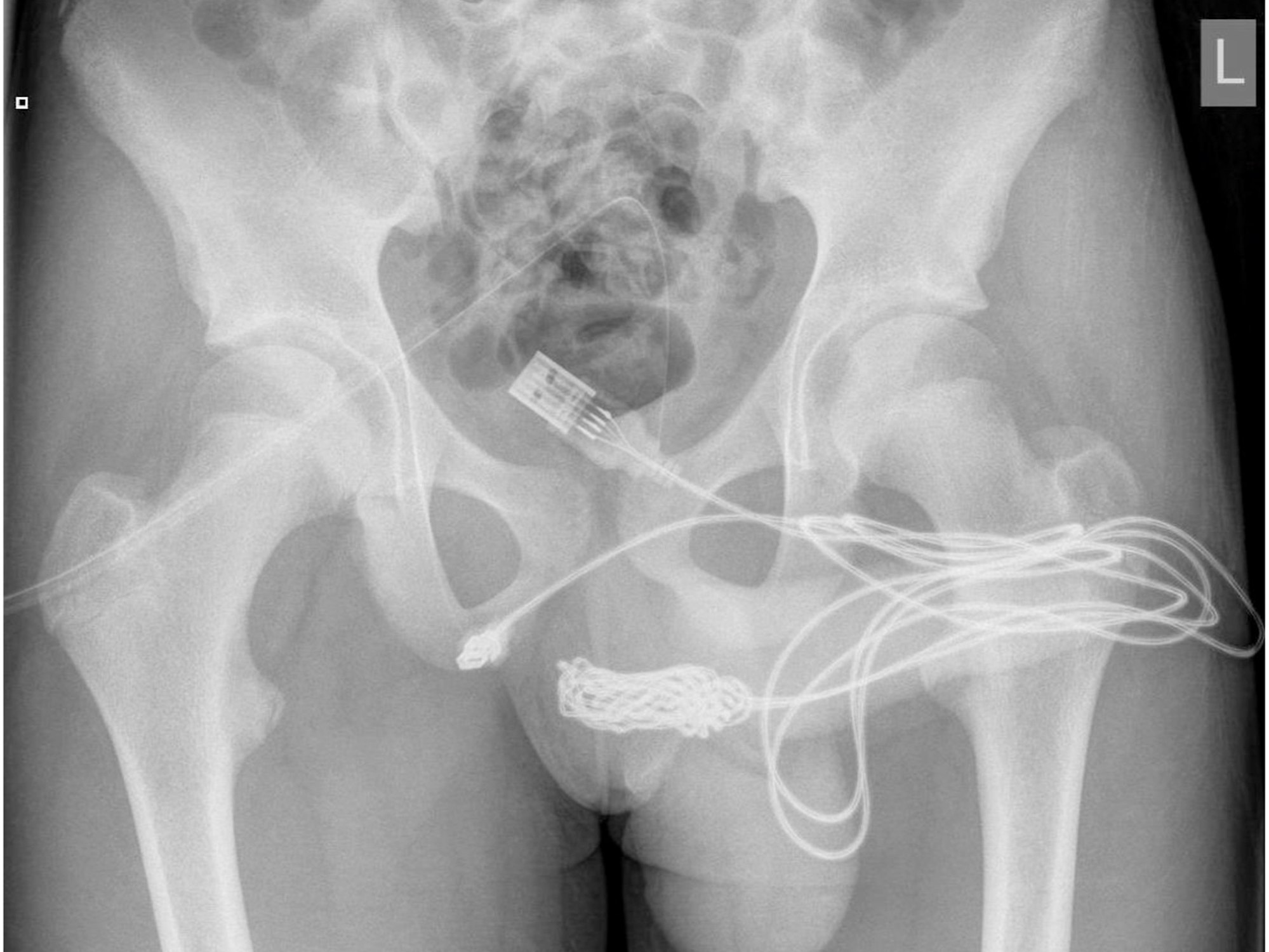 Auf dem Röntgenbild ist deutlich das verknotete USB-Kabel zu sehen, das im Körper des Jugendlichen stecken geblieben war. Der Teenager führte es bei einem fehlgeschlagenen sexuellen Experiment in seinen Penis ein.