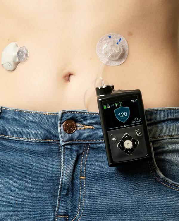 Auf dem Symbolfoto (aufgenommen am 29. Januar 2020) sieht man eine Frau mit Insulinpumpe am Bauch.