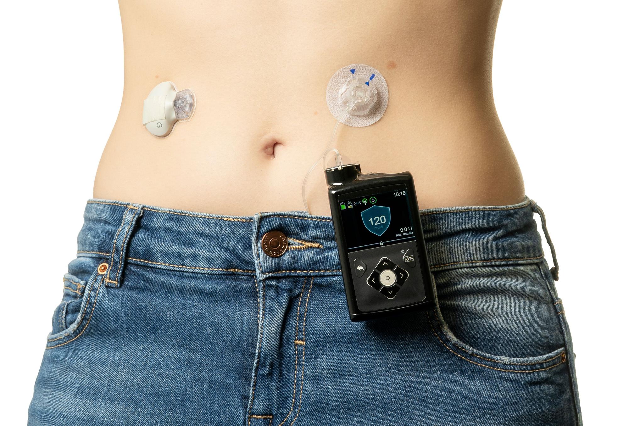 Auf dem Symbolfoto (aufgenommen am 29. Januar 2020) sieht man eine Frau mit Insulinpumpe am Bauch.