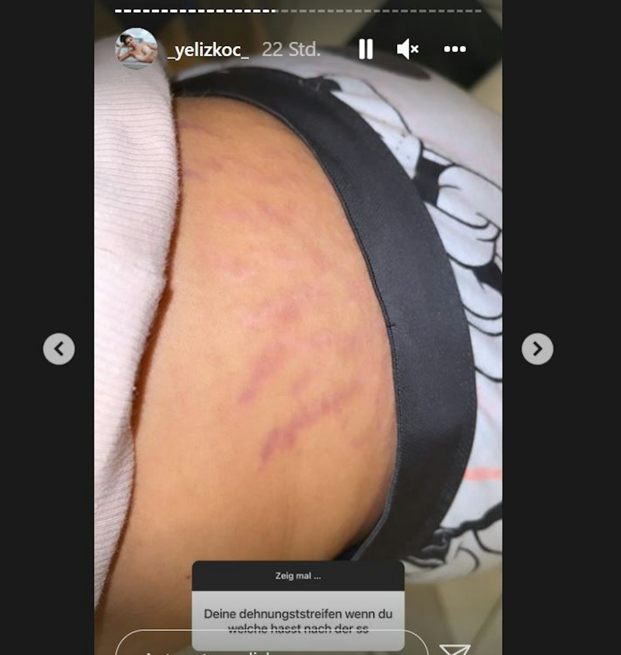 Yeliz Koc zeigt ihre Dehnungsstreifen nach der Schwangerschaft.