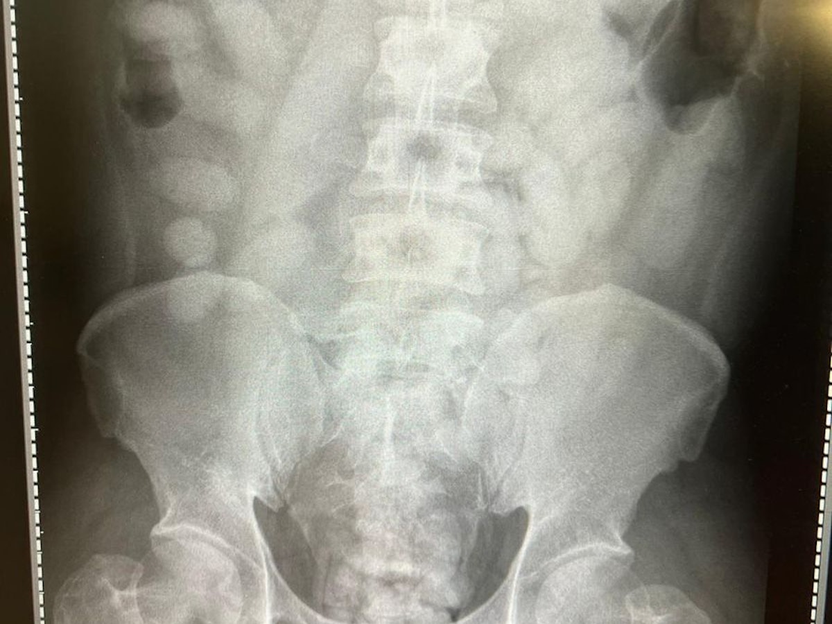 Auf dem Röntgenbild des Körperschmugglers sind ovale Päckchen zu sehen.
