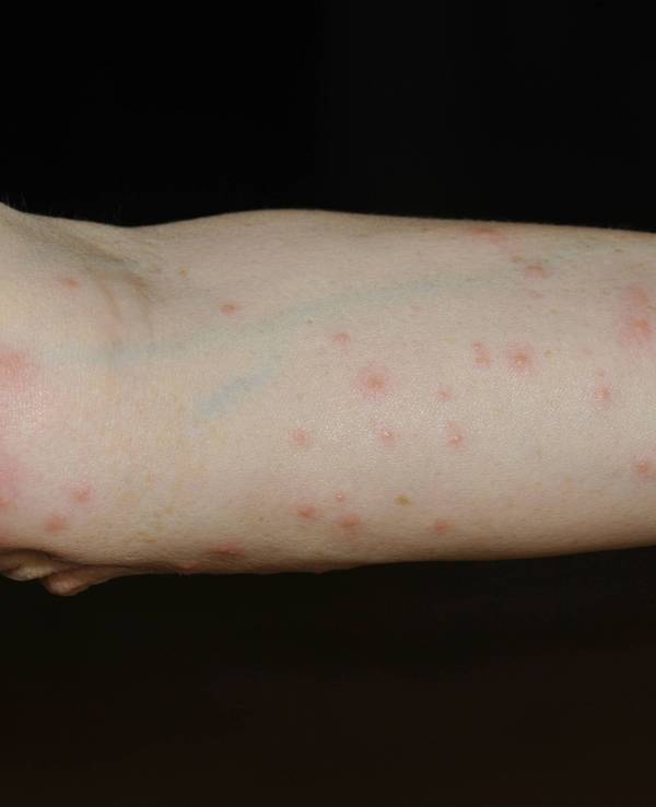 Arm mit rotem Ausschlag, verursacht durch Grasmilben.