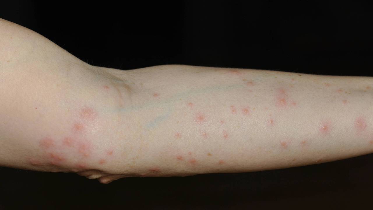 Arm mit rotem Ausschlag, verursacht durch Grasmilben.