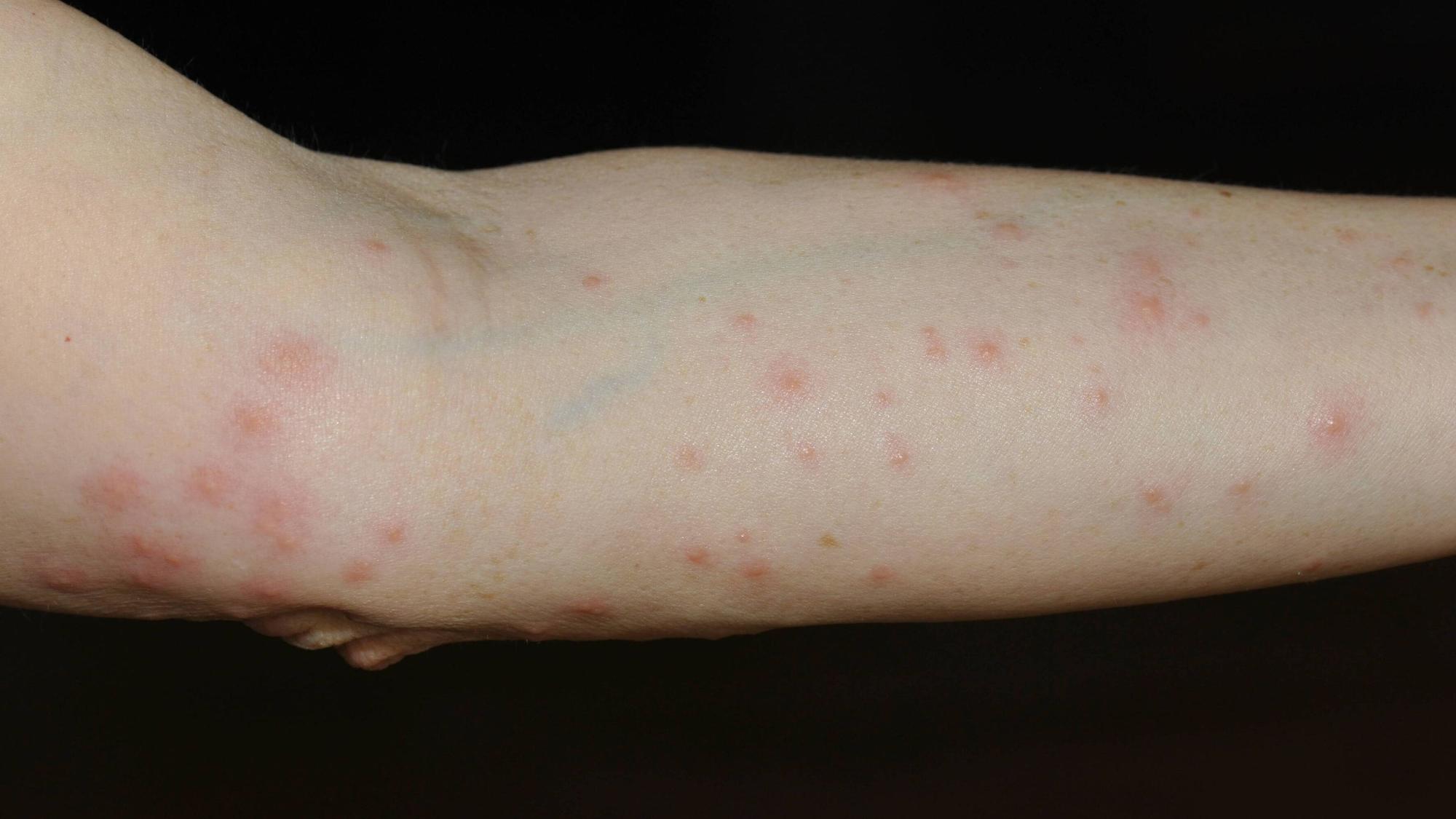 Arm mit rotem Ausschlag, verursacht durch Grasmilben.