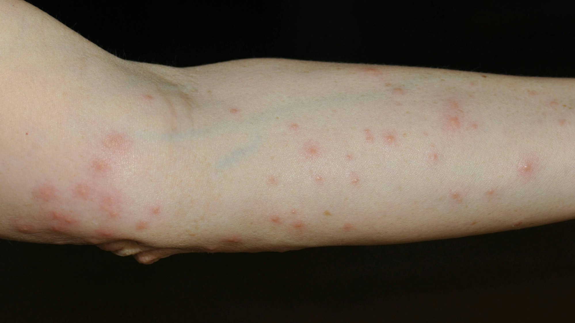 Arm mit rotem Ausschlag, verursacht durch Grasmilben.