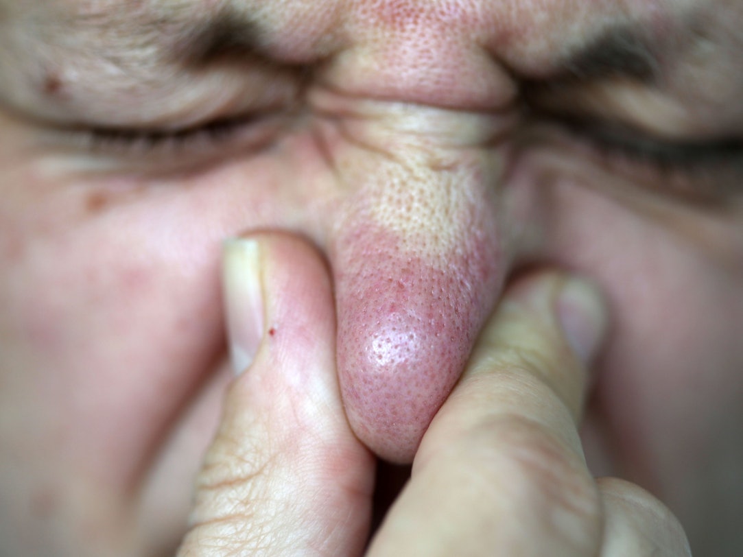 Das Symbolbild zeigt eine Person, die sich die Nase zuhält. Es wurde am 11. Juni 2013 aufgenommen.