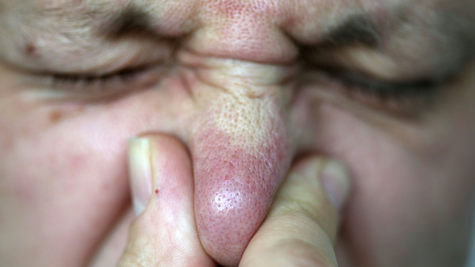 Das Symbolbild zeigt eine Person, die sich die Nase zuhält. Es wurde am 11. Juni 2013 aufgenommen.