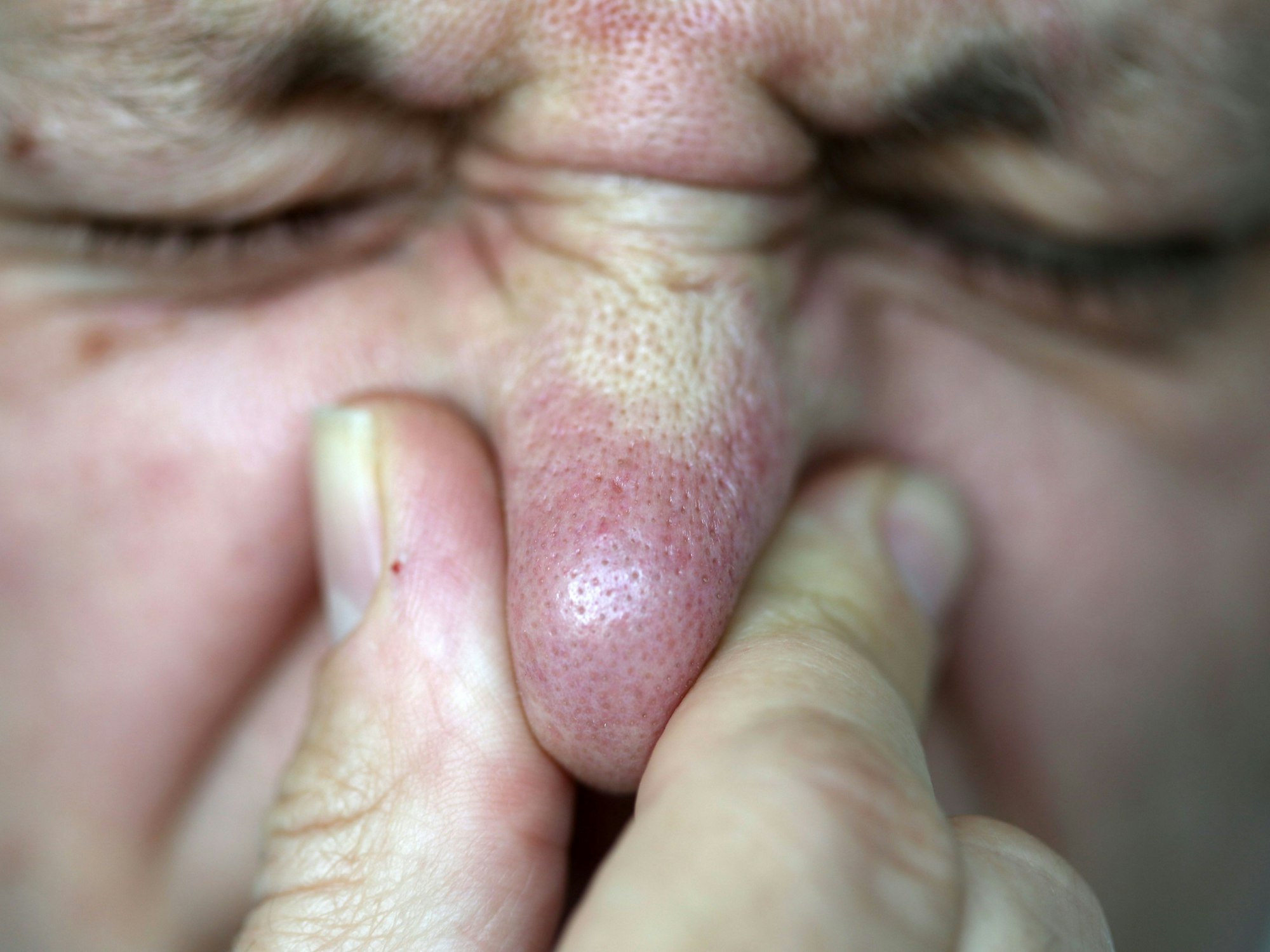 Eine Person hält sich die Nase zu.