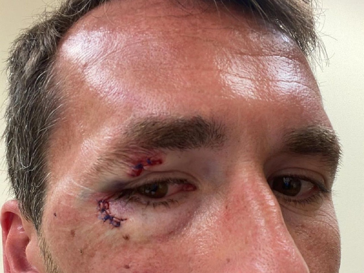 Christian Fuchs zeigt seine Verletzungen im Gesicht