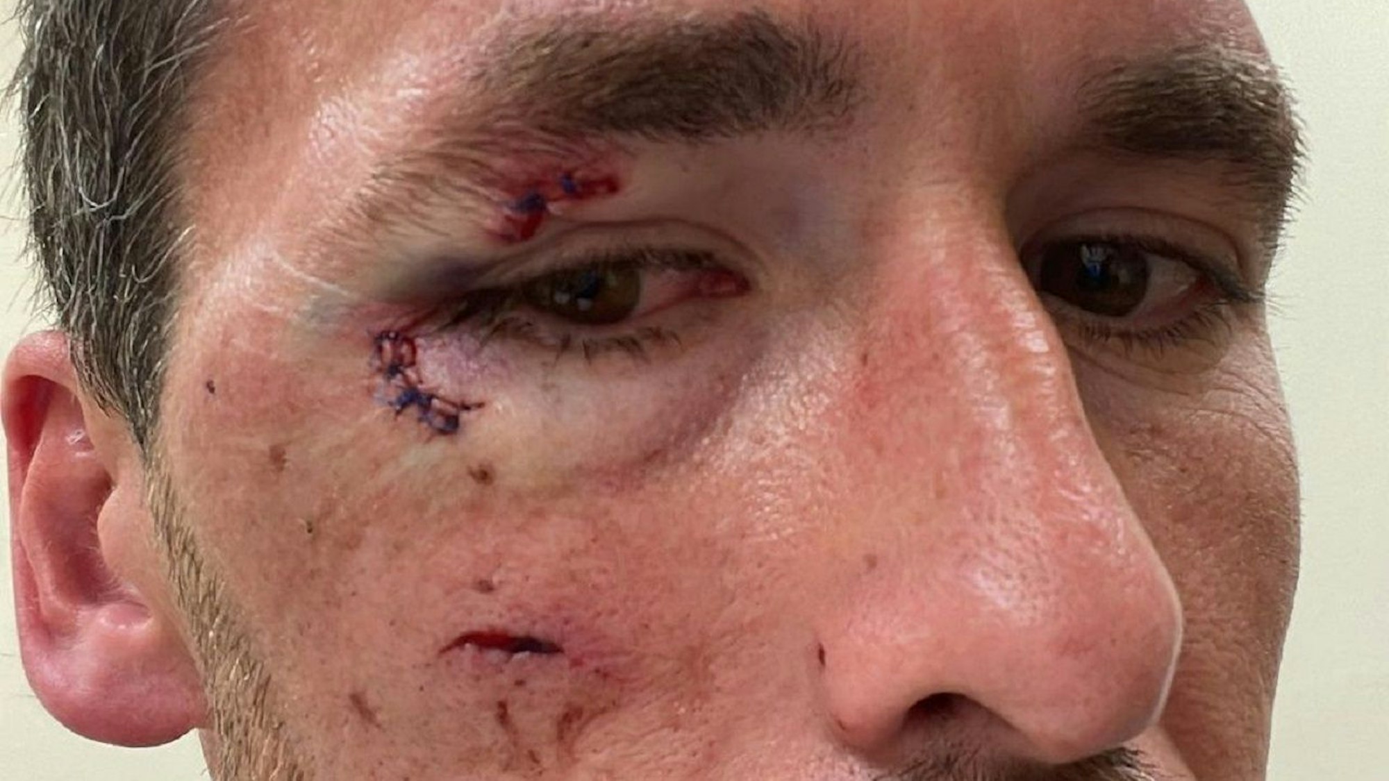 Christian Fuchs zeigt seine Verletzungen im Gesicht