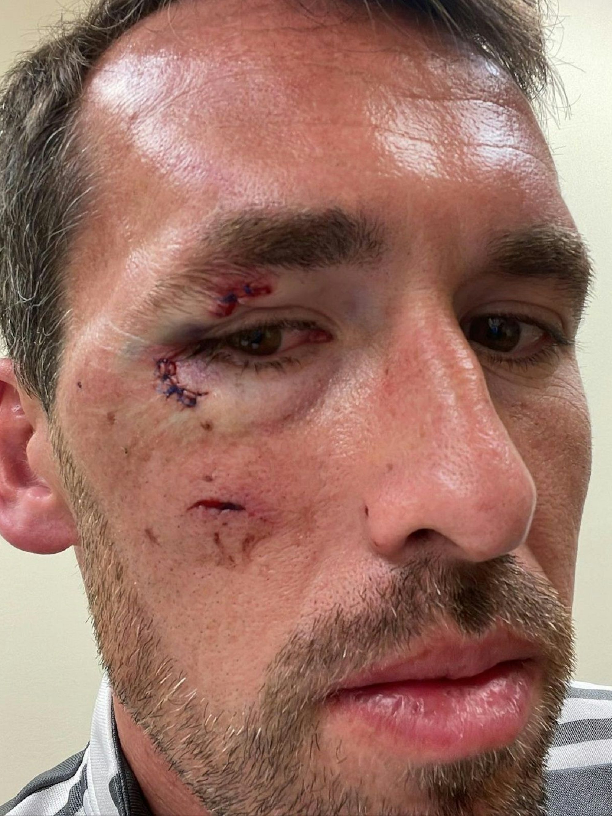 Christian Fuchs zeigt seine Verletzungen im Gesicht