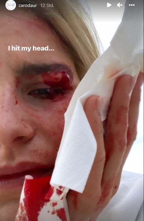 Influencerin Caro Daur hat sich am Auge verletzt.
