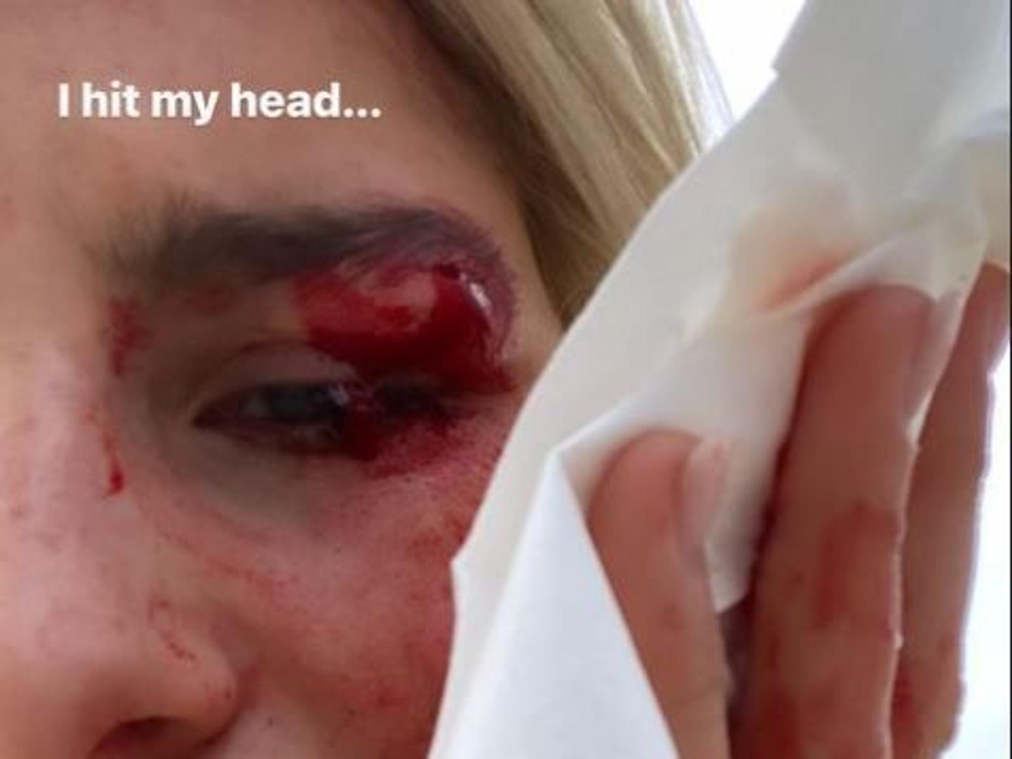 Influencerin Caro Daur hat sich am Auge verletzt.