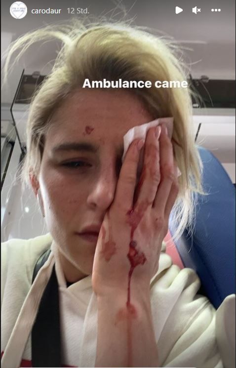 Influencerin Caro Daur hat sich am Auge verletzt