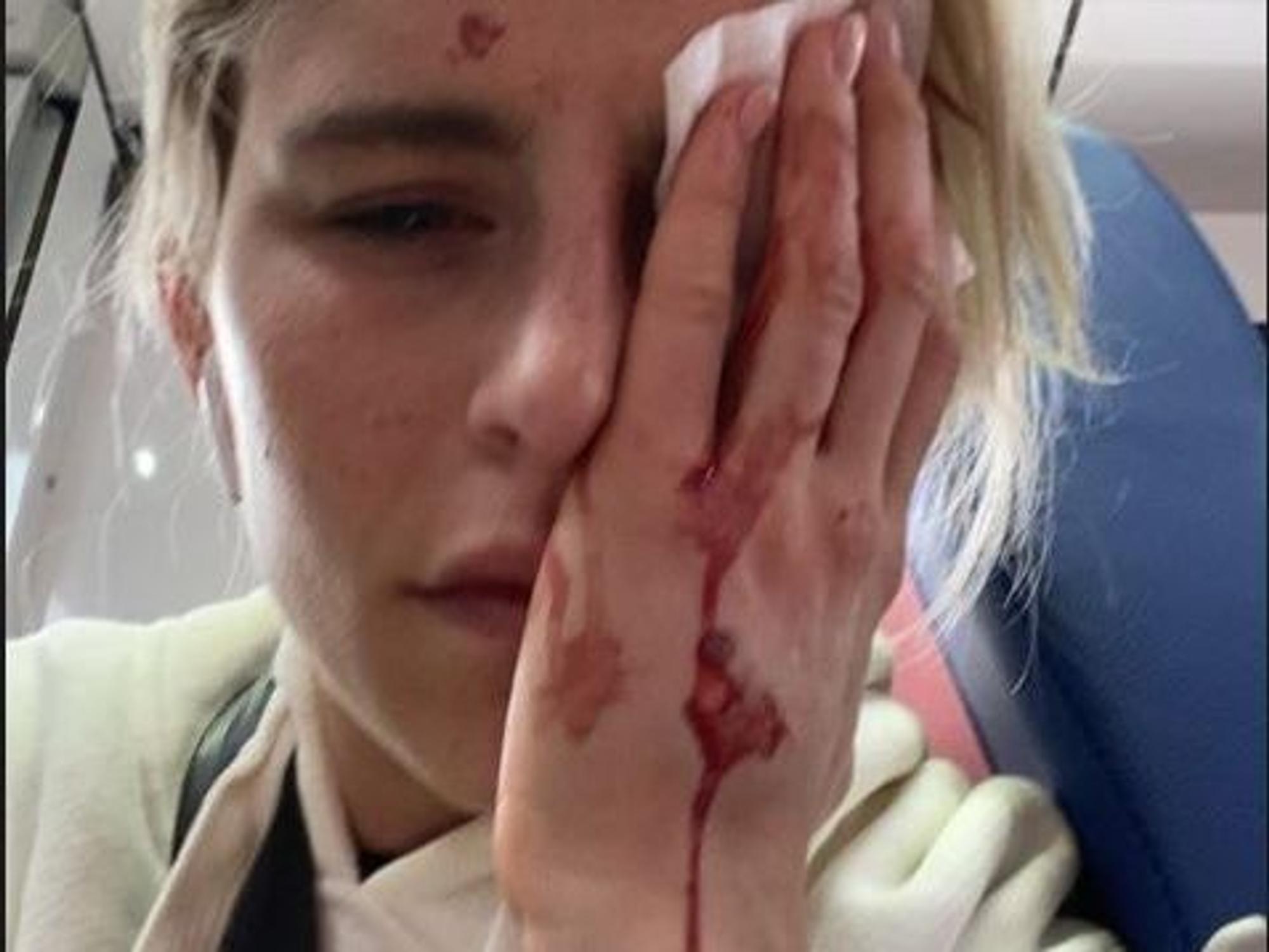 Influencerin Caro Daur hat sich am Auge verletzt