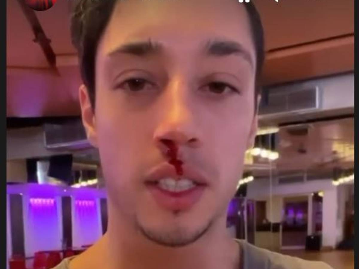 Lets Dance 2022: Kandidat René Casselly zeigt am 15. März 2022 in einer Instagram-Story die blutige Nase, die er sich im Training mit Kathrin Menzinger zugezogen hat.Screenshot zur Berichterstattung erstellt.Foto: Instagram/letsdance