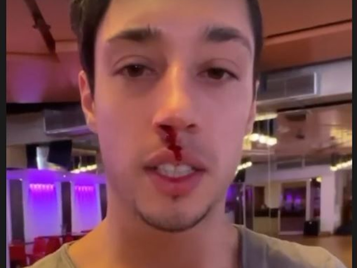 Lets Dance 2022: Kandidat René Casselly zeigt am 15. März 2022 in einer Instagram-Story die blutige Nase, die er sich im Training mit Kathrin Menzinger zugezogen hat.Screenshot zur Berichterstattung erstellt.Foto: Instagram/letsdance