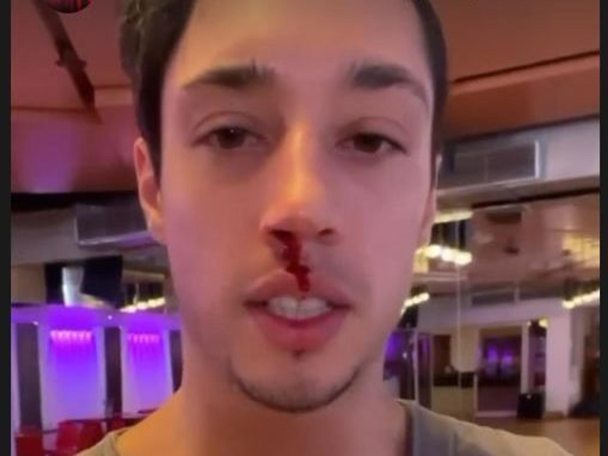 Lets Dance 2022: Kandidat René Casselly zeigt am 15. März 2022 in einer Instagram-Story die blutige Nase, die er sich im Training mit Kathrin Menzinger zugezogen hat.Screenshot zur Berichterstattung erstellt.Foto: Instagram/letsdance