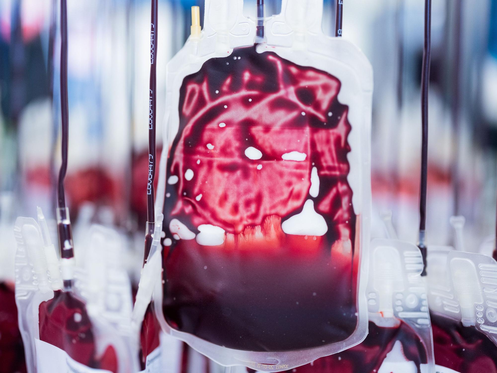 Mikroplastik wurde nun erstmals im menschlichen Blut (hier ein Symbolfoto) nachgewiesen.