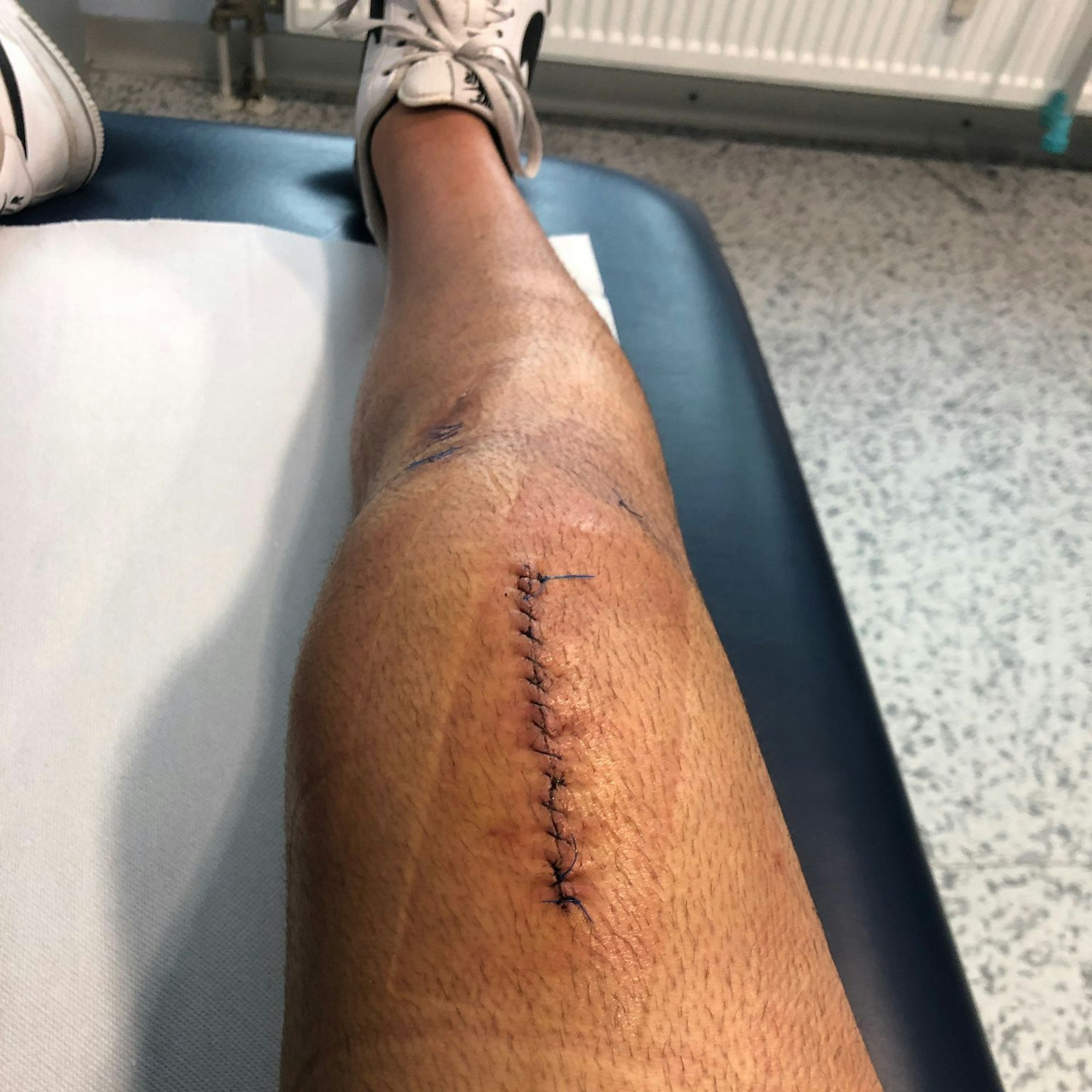 Das mehrmals operierte Knie von Kürsat Karadag.
