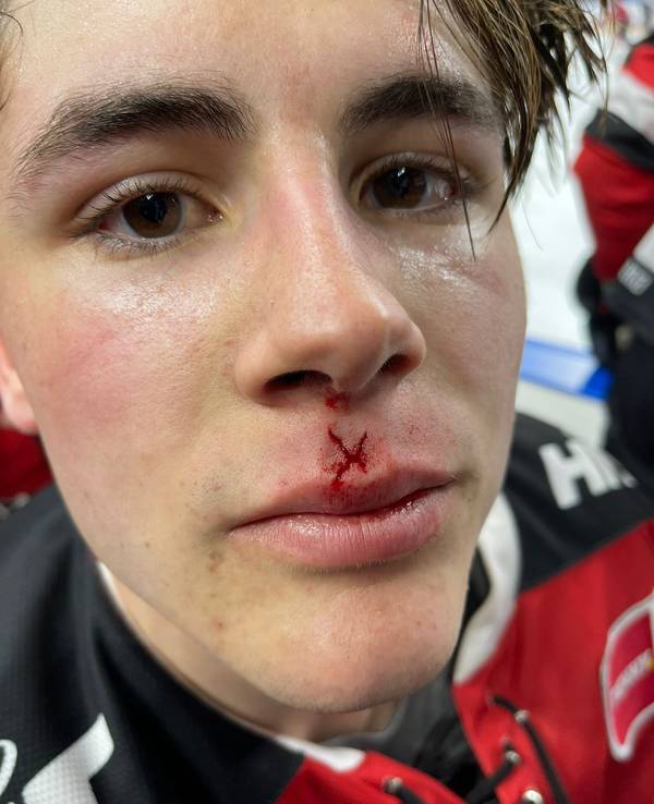 Luis Üffing, Stürmer der Kölner Haie, mit einem Cut nach dem DEL-Spiel gegen Ingolstadt.