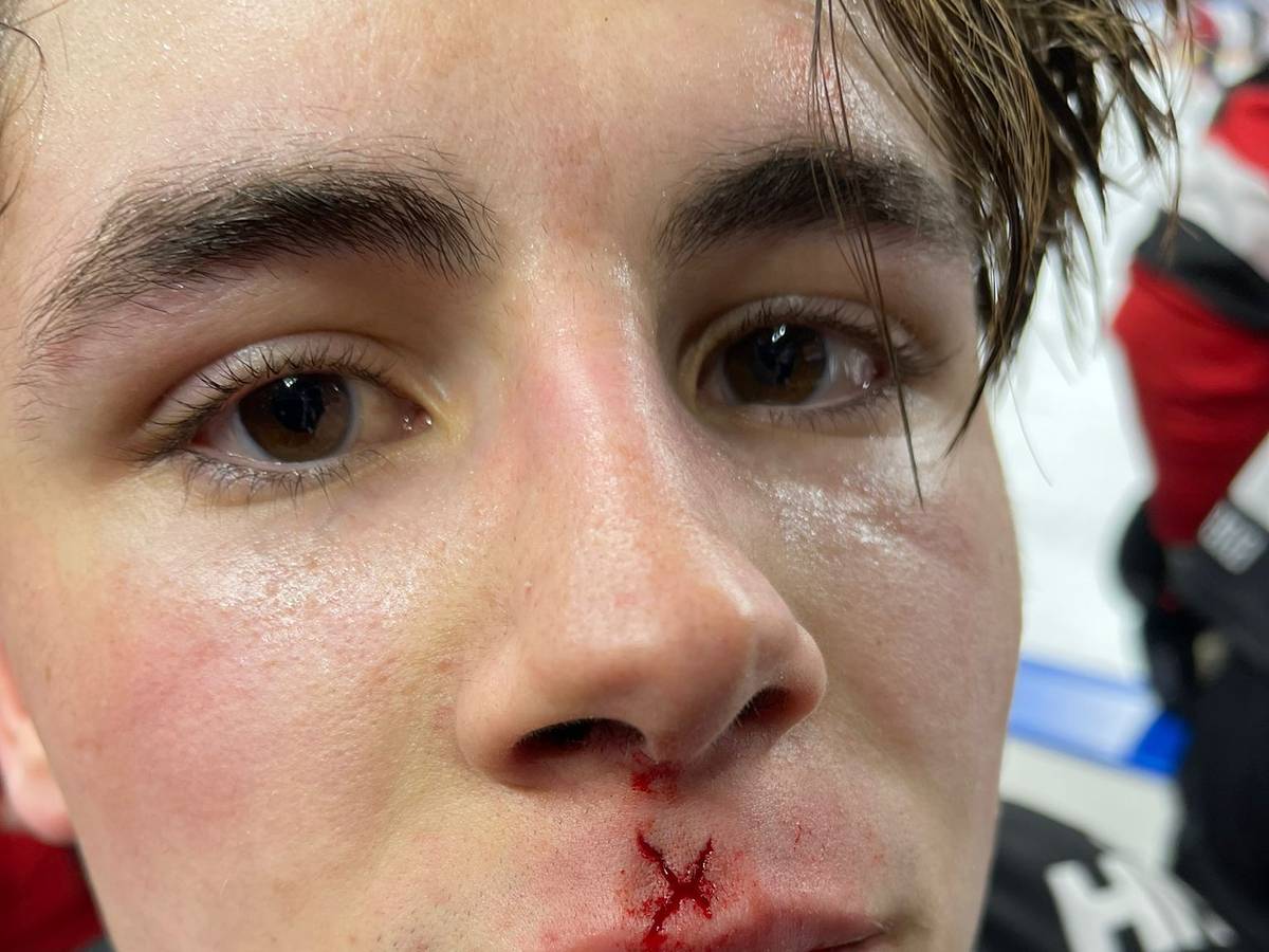 Luis Üffing, Stürmer der Kölner Haie, mit einem Cut nach dem DEL-Spiel gegen Ingolstadt.