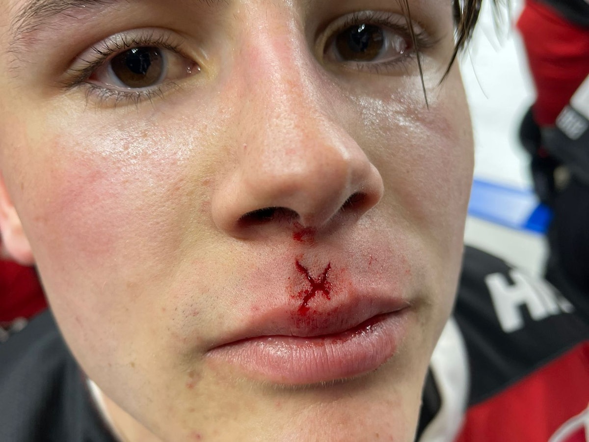 Luis Üffing, Stürmer der Kölner Haie, mit einem Cut nach dem DEL-Spiel gegen Ingolstadt.