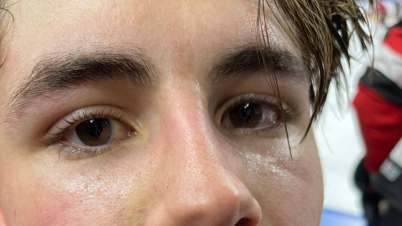 Luis Üffing, Stürmer der Kölner Haie, mit einem Cut nach dem DEL-Spiel gegen Ingolstadt.