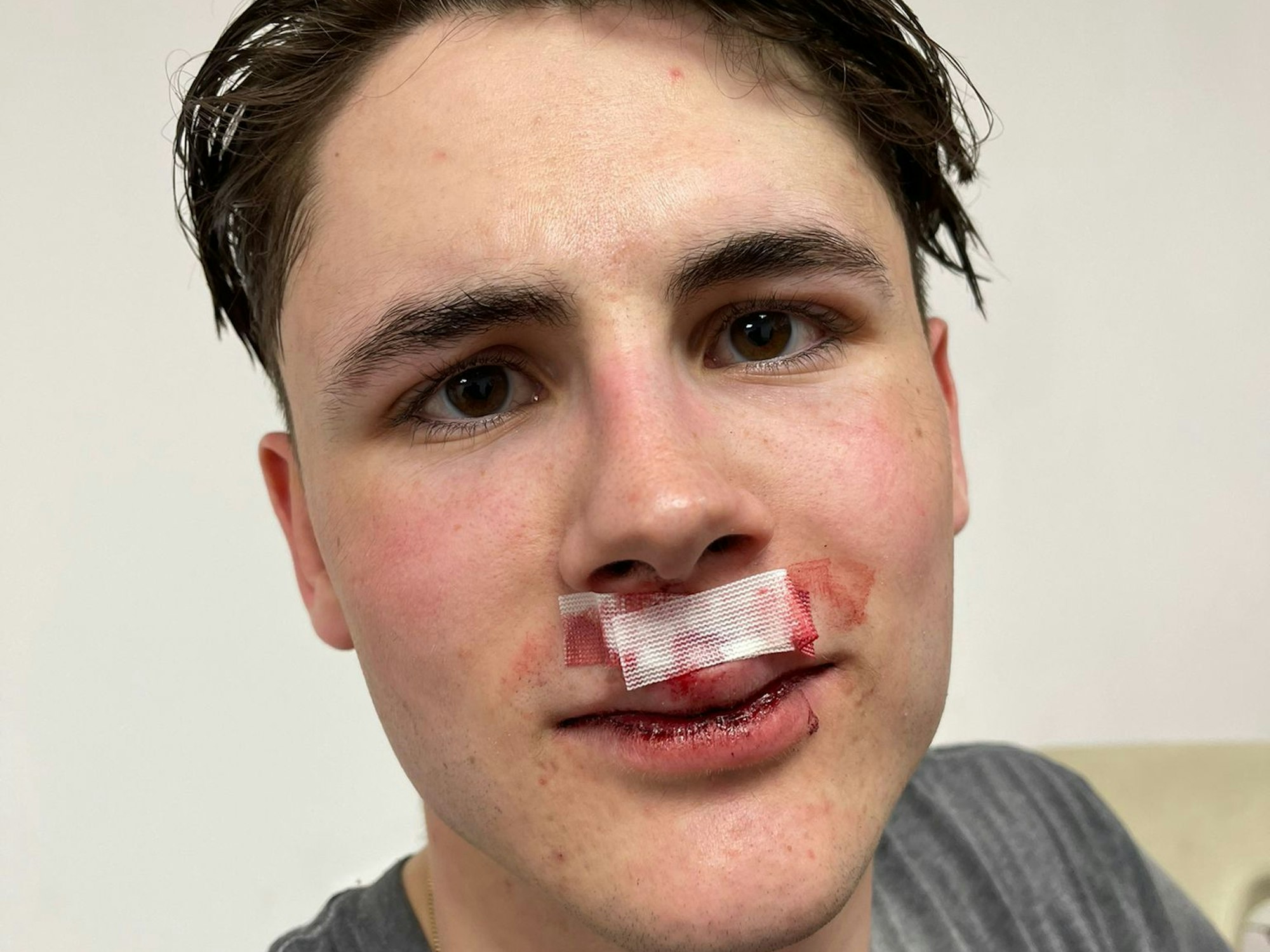 Luis Üffing (Kölner Haie) mit geklebter Wunde.