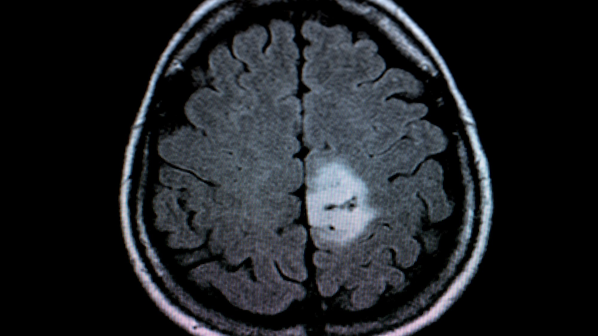 Das Foto zeigt das MRT-Bild eines Gehirntumors (heller Fleck), aufgenommen am 1.12.2009 im Universitätsklinikum (UKM) in Münster.
