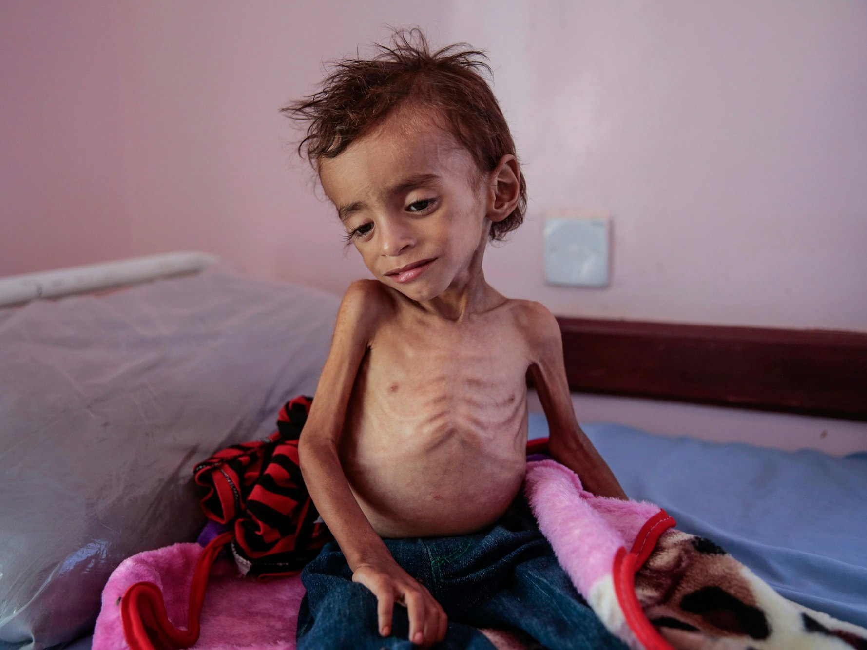 Ein unterernährter Junge sitzt auf einem Krankenhausbett im Aslam Health Center in Hadschah im Jemen im Oktober 2018