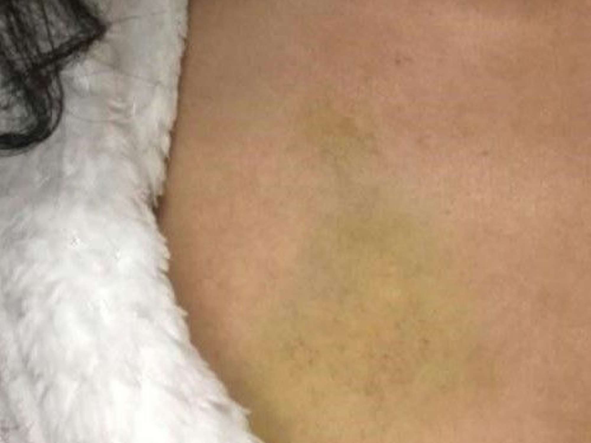 Ein Bluterguss auf dem Brustkorb einer Frau