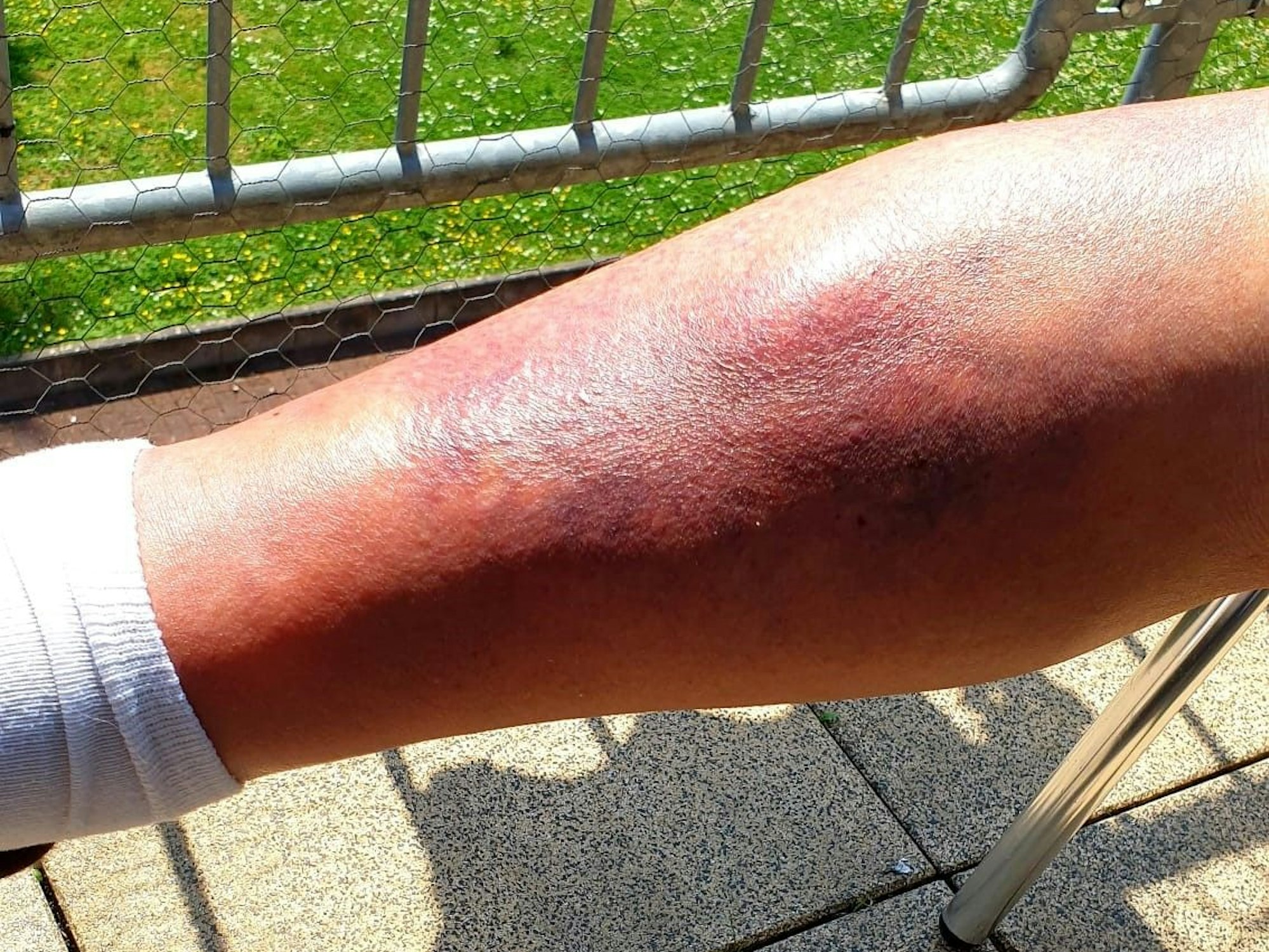 Das Hämatom am Unterschenkel der 87-Jährigen.