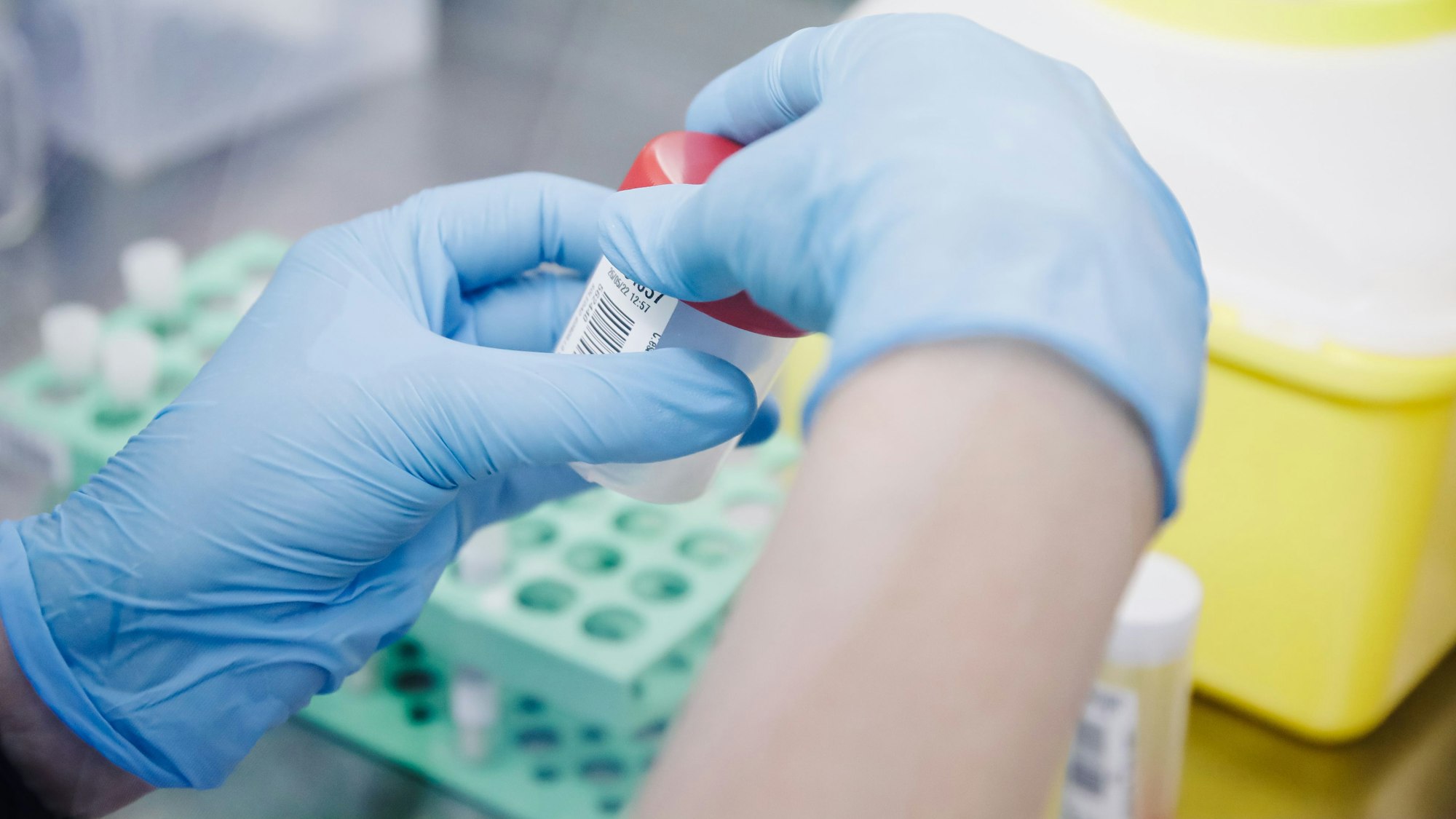 Affenpocken: Der Erreger breitet sich in Europa aus. Unser Foto zeigt einen Affenpockentest im Labor 2022.