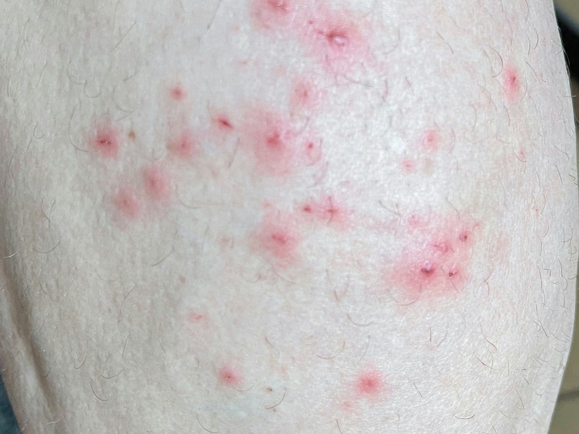 Das vom Institute of Tropical Medicine Antwerpen am 25. Mai 2022 zur Verfügung gestellte Foto zeigt Hautsymptome von Affenpocken-Patienten.