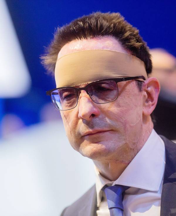 Bernhard Günther wurde bei dem Säure-Anschlag schwer verletzt. Unser Foto zeigt ihn 2020 mit einem Verband um den Kopf.