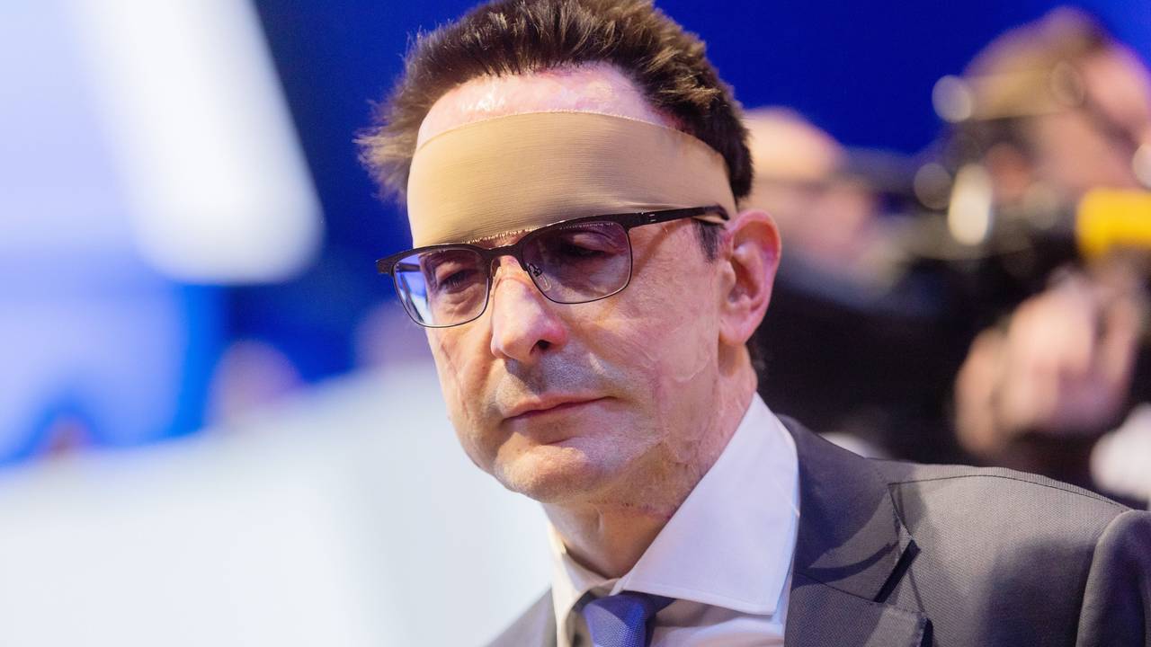 Bernhard Günther wurde bei dem Säure-Anschlag schwer verletzt. Unser Foto zeigt ihn 2020 mit einem Verband um den Kopf.