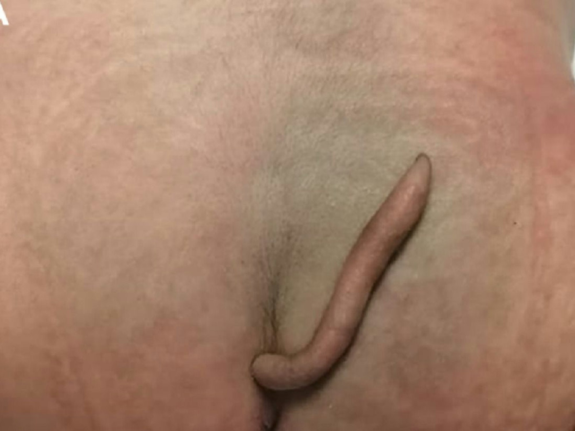 Schwanz am Po eines neugeborenen Mädchens.